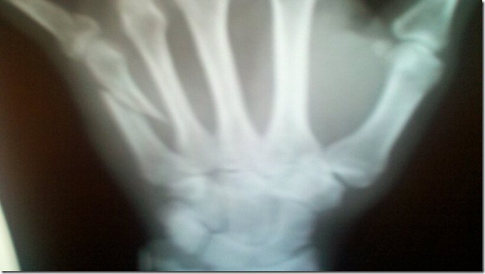 broken finger