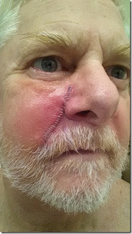 48 hours post-op